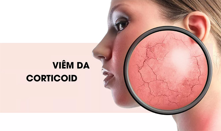 Da nhiễm Corticoid Dấu hiệu và cách điều trị Tinh tế Beauty